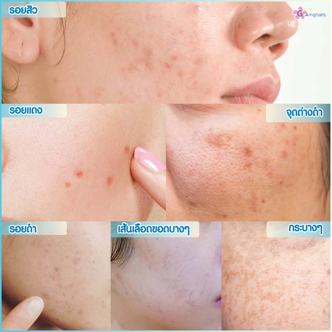 เลเซอร์หน้าใส ลดรอยดำรอยแดงจากสิว รักษาจุดด่างดำ ครั้งแรกเห็นผล เลเซอร์หน้าใส ลดรอยดำรอยแดงจากสิว รักษาจุดด่างดำ ครั้งแรกเห็นผล