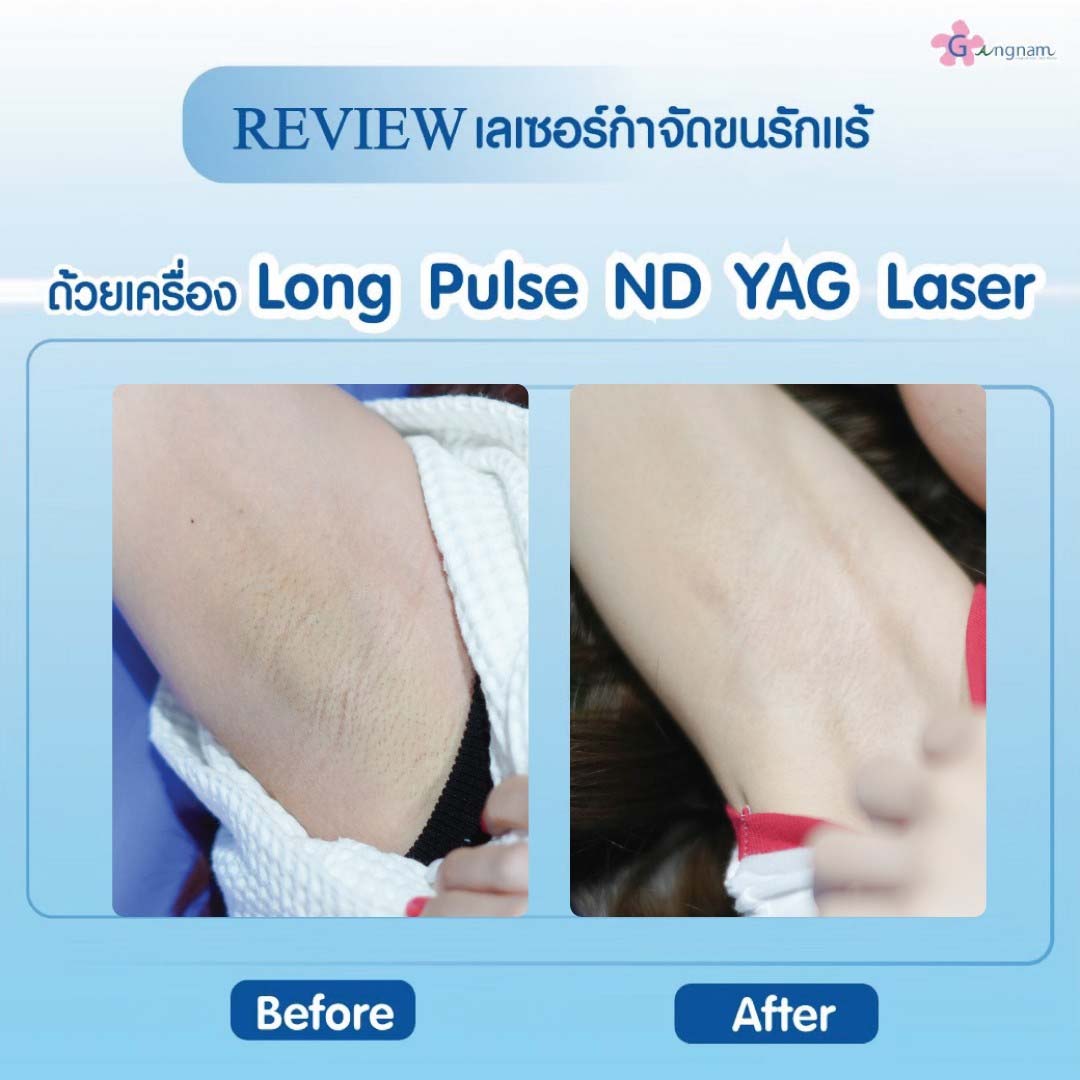 เลเซอร์กำจัดขน เลเซอร์รักแร้ ลงลึกถึงรากถึงโคน ทดลองฟรีที่กังนัมคลินิก เลเซอร์กำจัดขน เลเซอร์รักแร้ ลงลึกถึงรากถึงโคน ทดลองฟรีที่กังนัมคลินิก