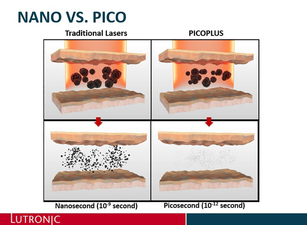 Nanosecnd VS Picosecond