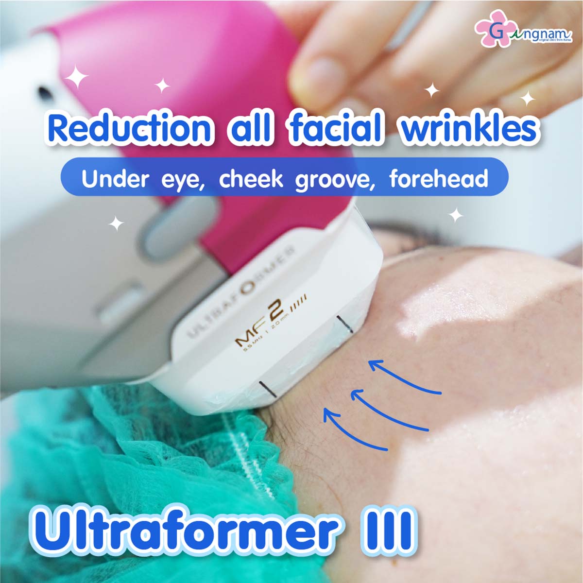 Where is popular to get Ultraformer III