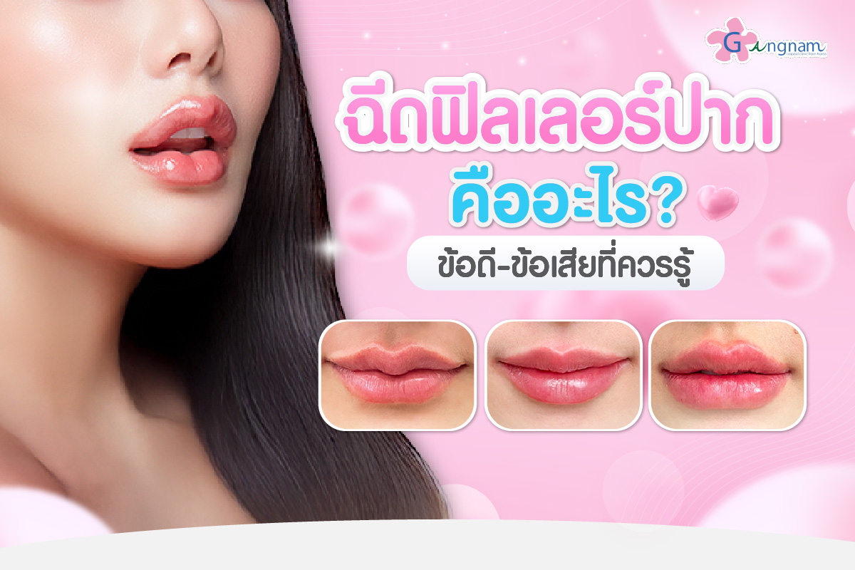 Lip filler