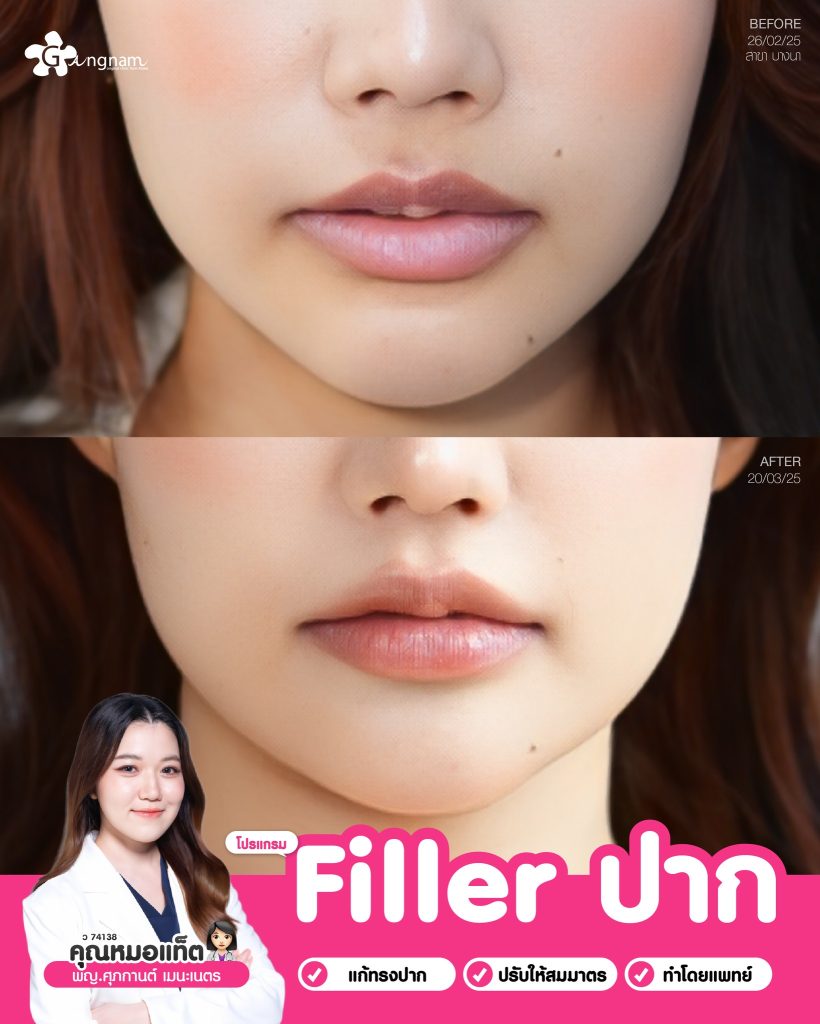 รีวิว ฟิลเลอร์ปาก 01