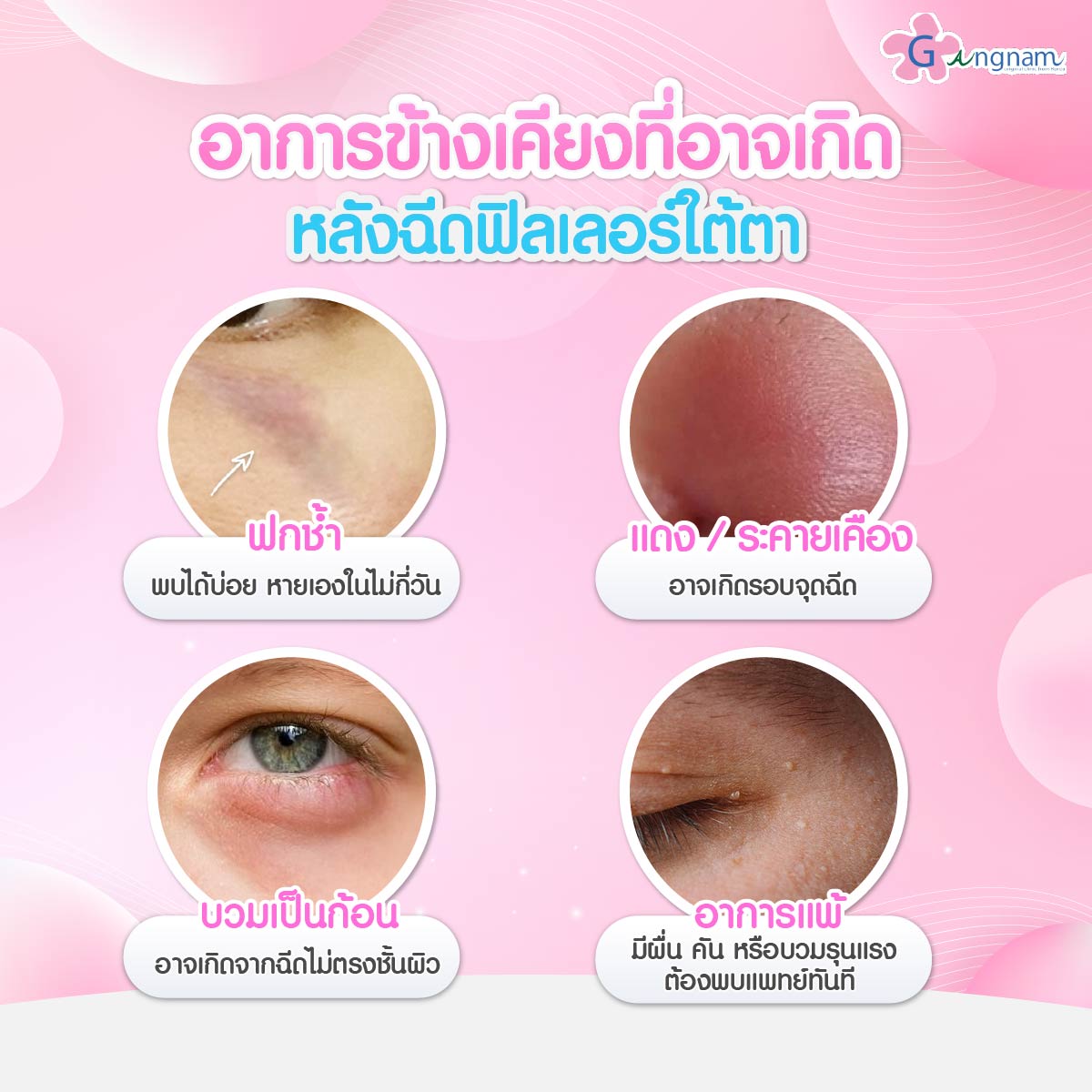 อาการข้างเคียงฉีดฟิลเลอร์ใต้ตา