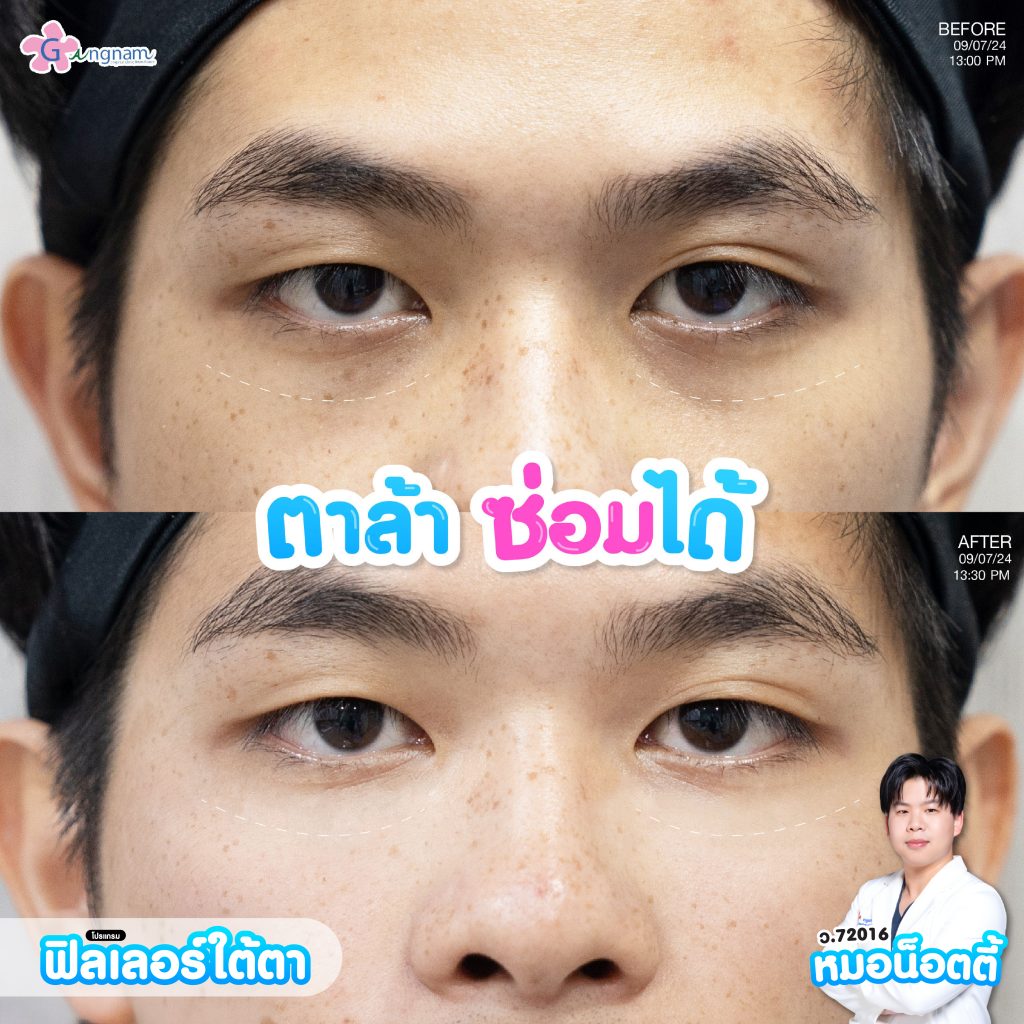 ฟิลเลอร์ใต้ตา 1