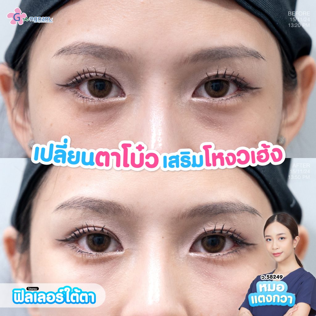 ฟิลเลอร์ใต้ตา 2