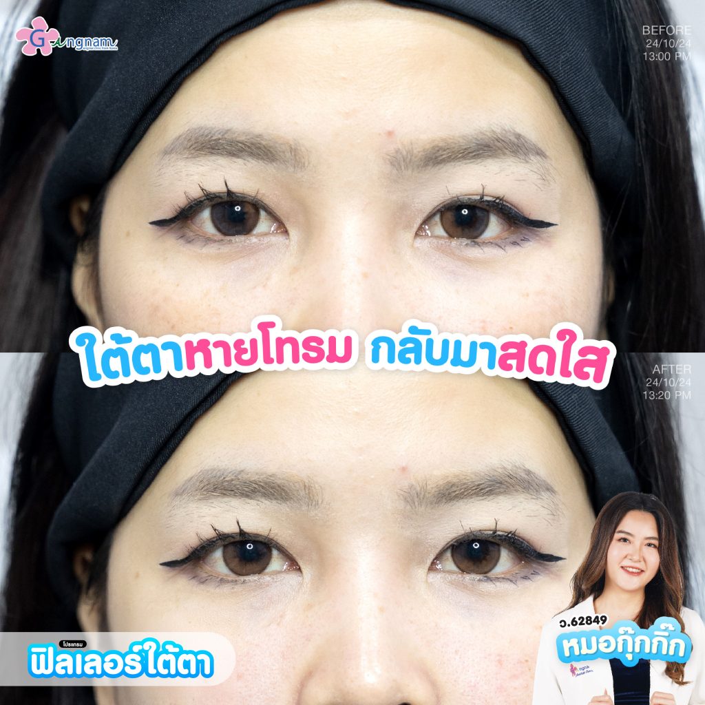 ฟิลเลอร์ใต้ตา 4