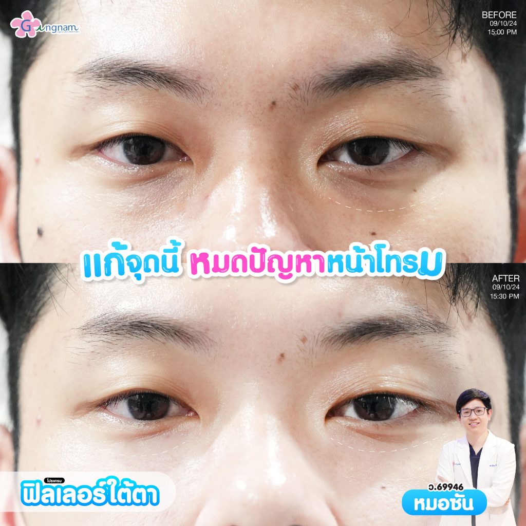 ฟิลเลอร์ใต้ตา 6