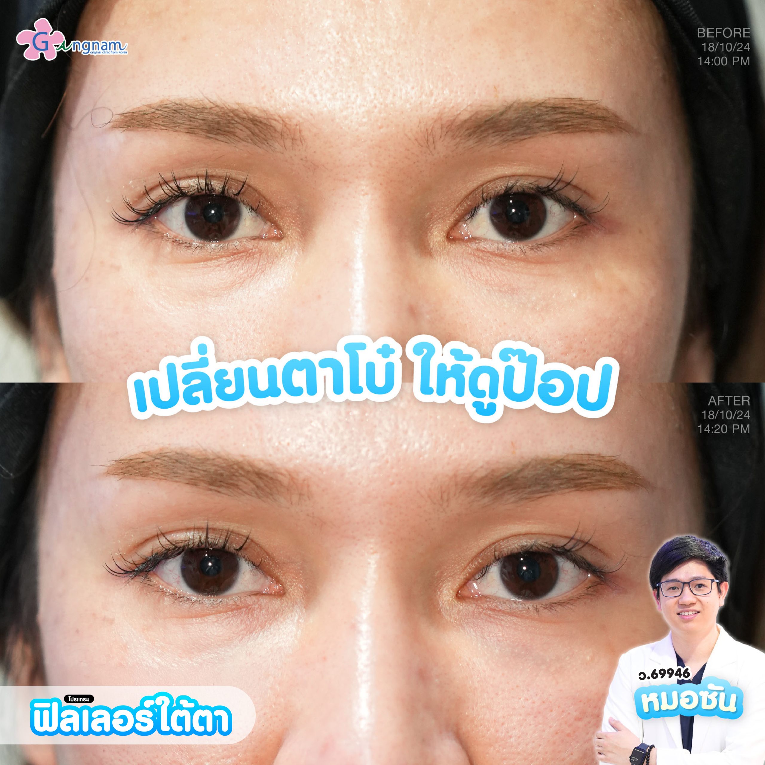 ฟิลเลอร์ใต้ตา 5