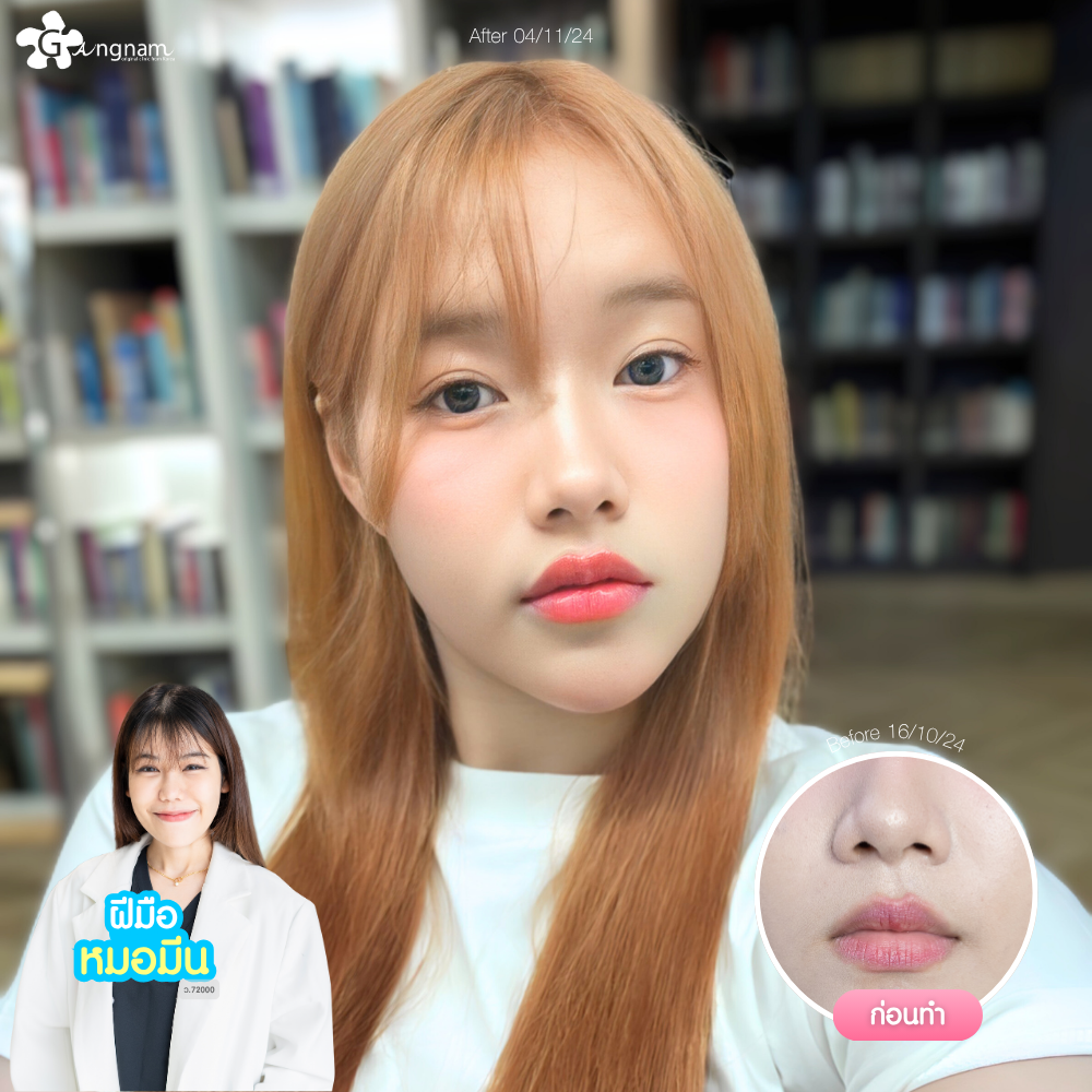 ผลลัพธ์หลังฉีดฟิลเลอร์ปาก 01
