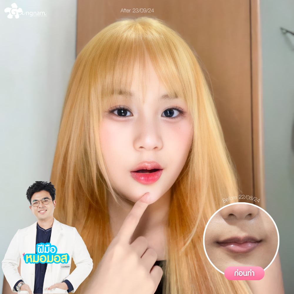 ผลลัพธ์หลังฉีดฟิลเลอร์ปาก 02