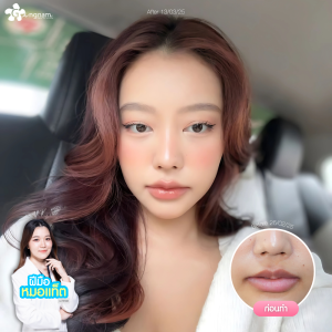 ผลลัพธ์หลังฉีดฟิลเลอร์ปากของคุณจิ๋ว ดาวติ๊กต๊อก