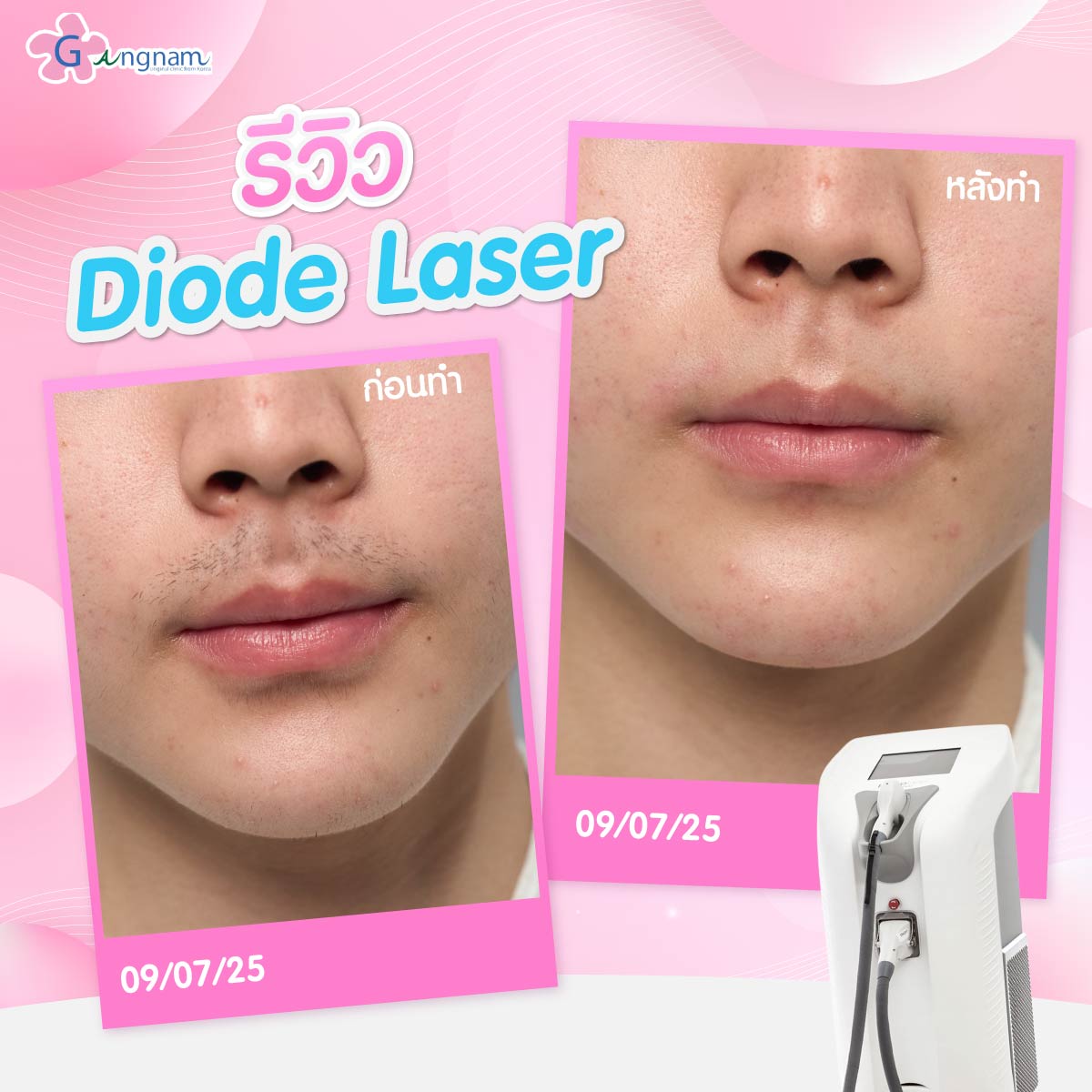 Diode Laser 02