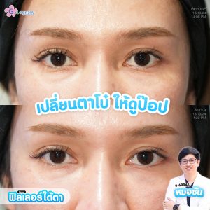 รีวิวฉีดฟิลเลอร์ใต้ตา 2