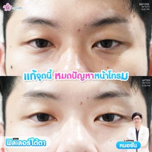 รีวิวฉีดฟิลเลอร์ใต้ตา