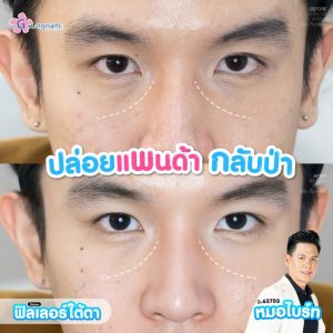 รีวิวฉีดฟิลเลอร์ใต้ตา-หมอไบร์ท