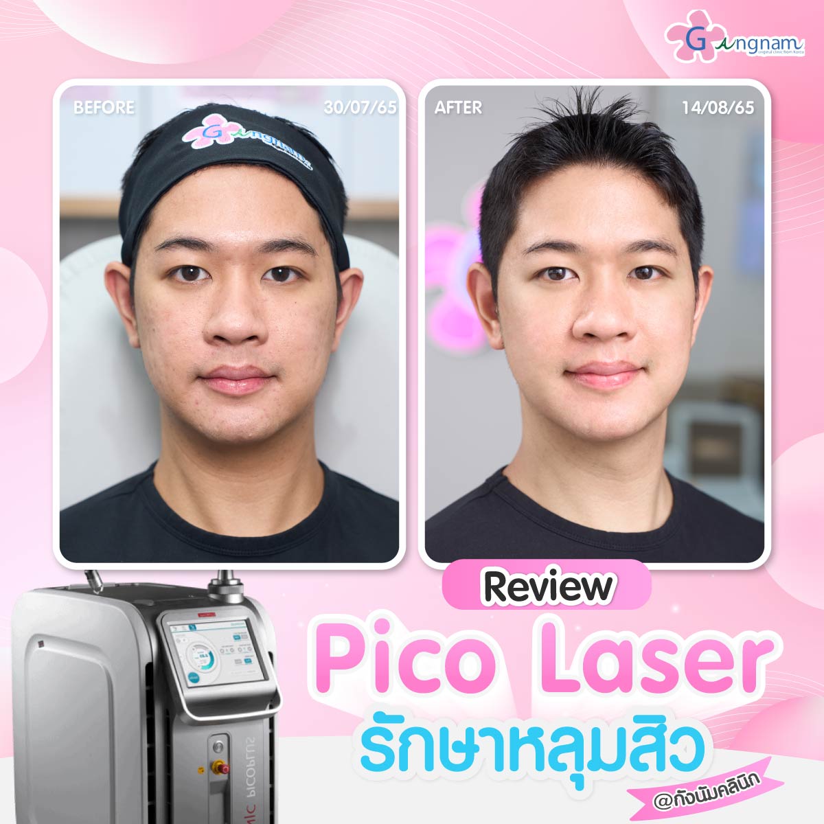 รีวิว รักษาหลุมสิวด้วย Pico Laser