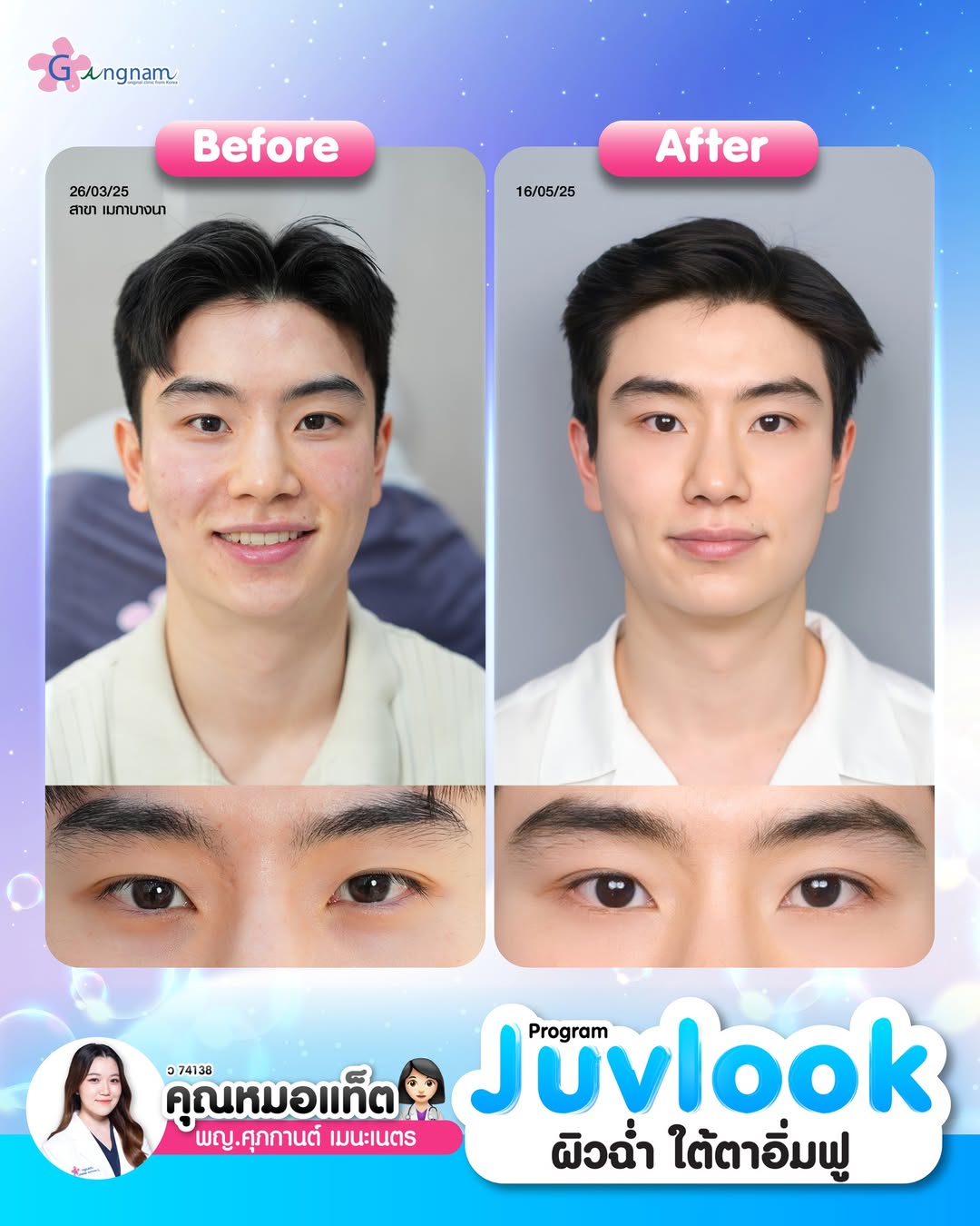 รีวิวไหมน้ำโปรแกรม juvelook