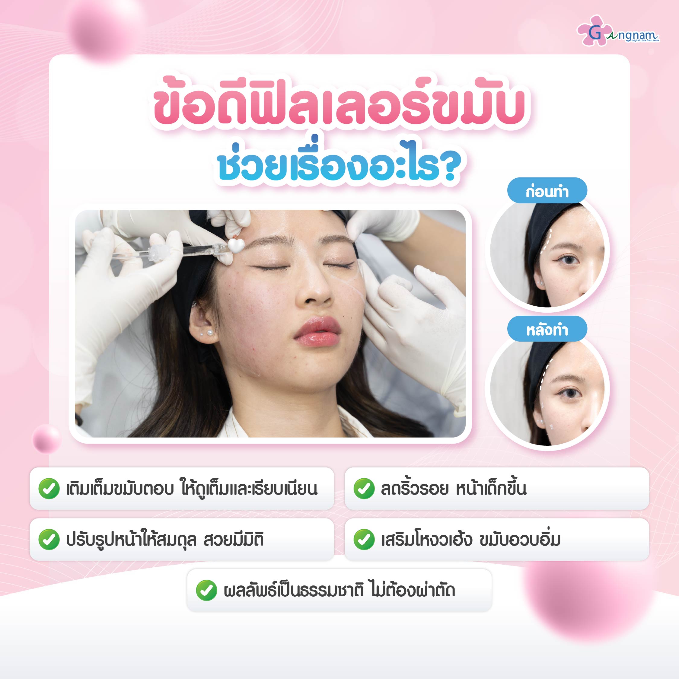 ประโยชน์ฟิลเลอร์ขมับ