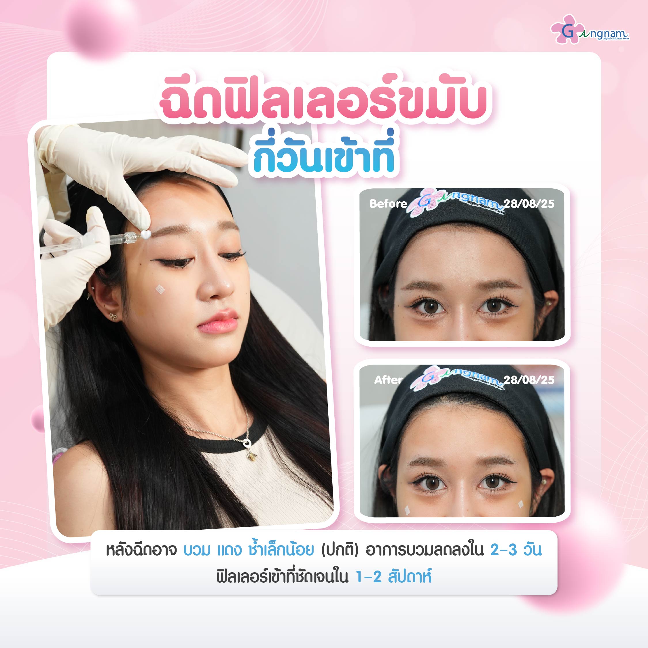 ฟิลเลอร์ขมับกี่วันเข้าที่