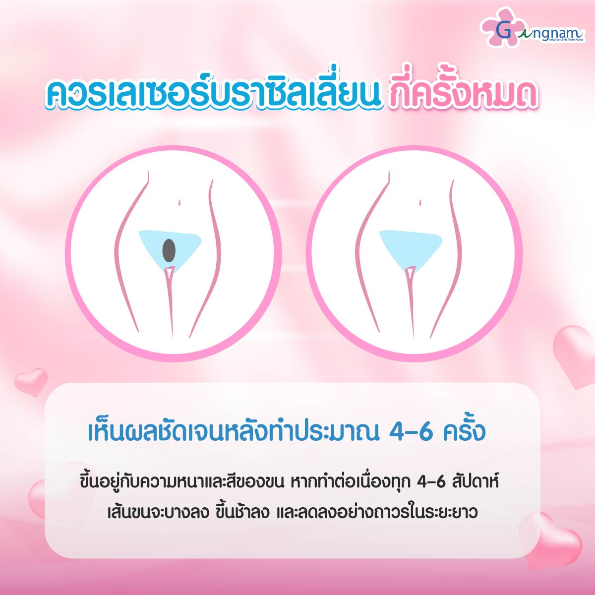 จำนวนครั้งเลเซอร์บราซิลเลี่ยน