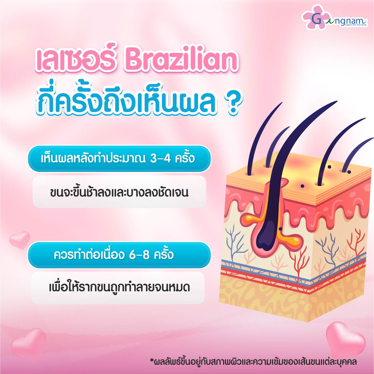 ระยะเห็นผลลัพธ์เลเซอร์บราซิลเลี่ยน