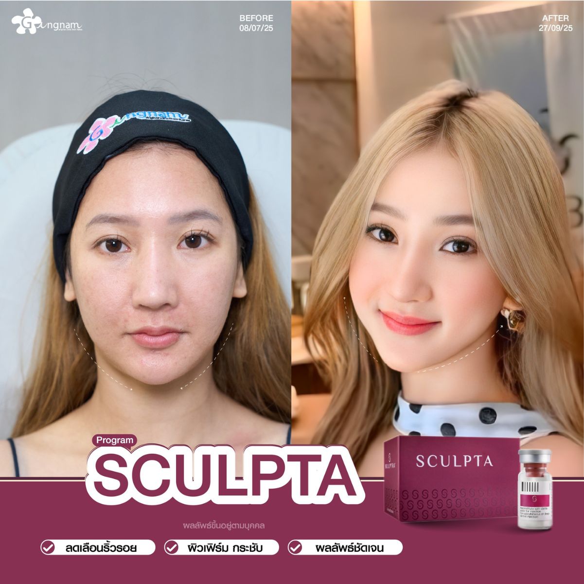 Sculptra ฉีดลดเรือนริ้วรอย