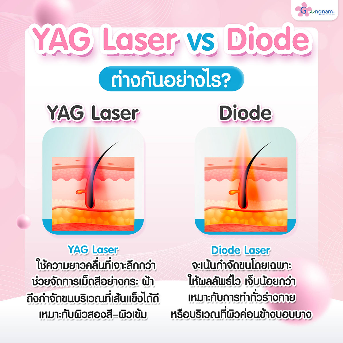 YAG Laser vs Diode ต่างกันอย่างไร
