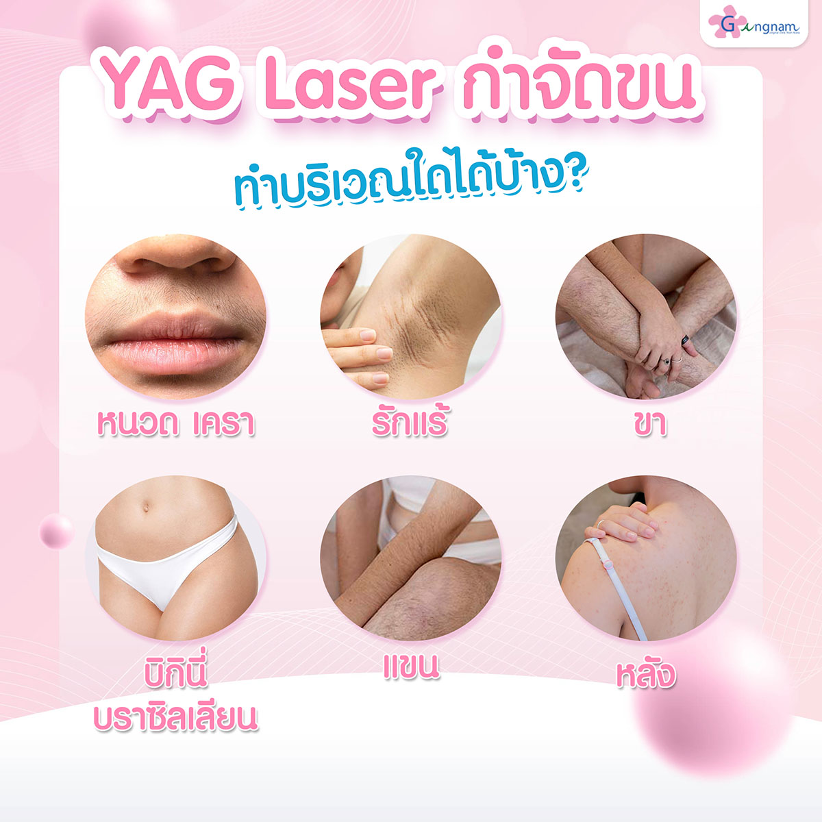 YAG Laser กําจัดขนทำบริเวณใดบ้าง