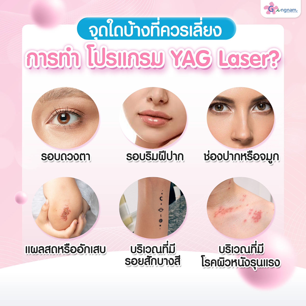 จุดใดบ้างที่ควรเลี่ยงการทำ โปรแกรม YAG Laser