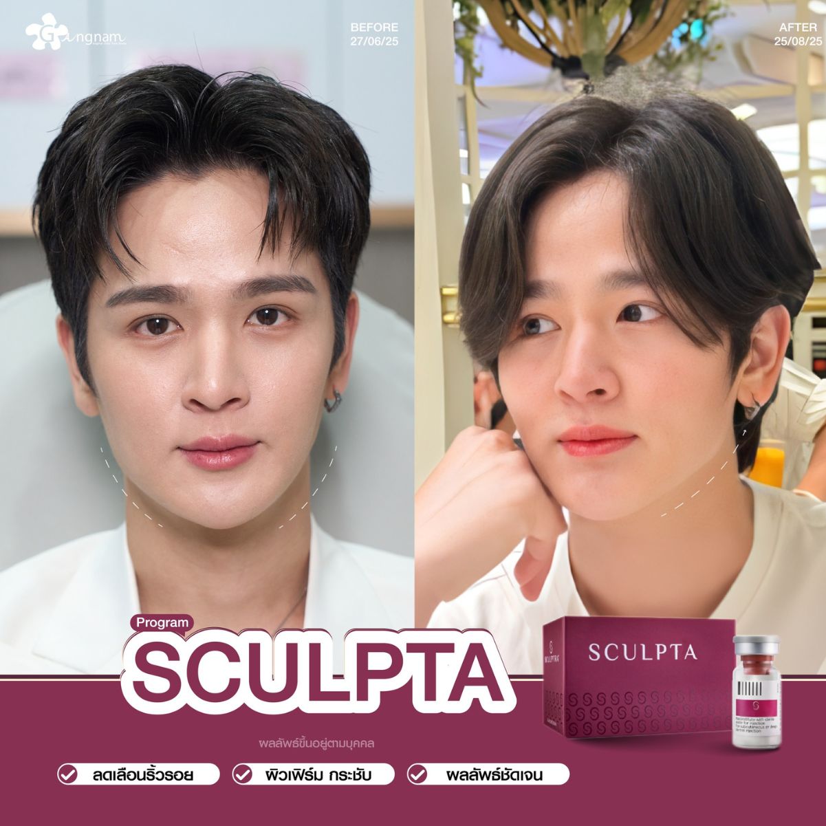 ผู้ชายฉีดSculptra กระชับหน้า