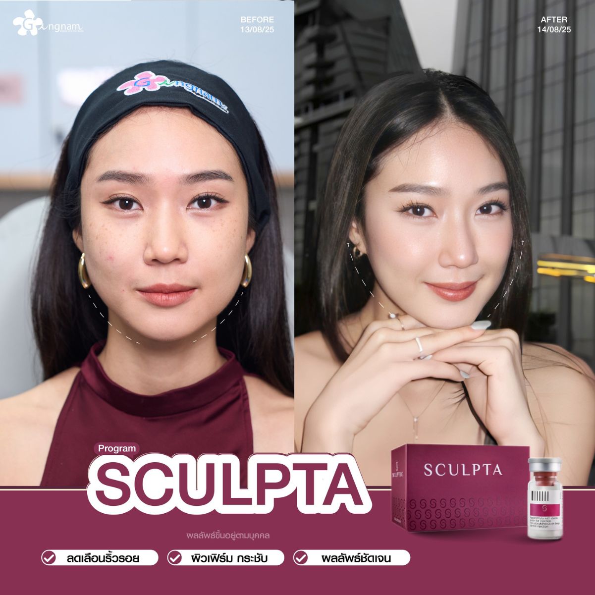 ผู้หญิงฉีดSculptra กระชับหน้า