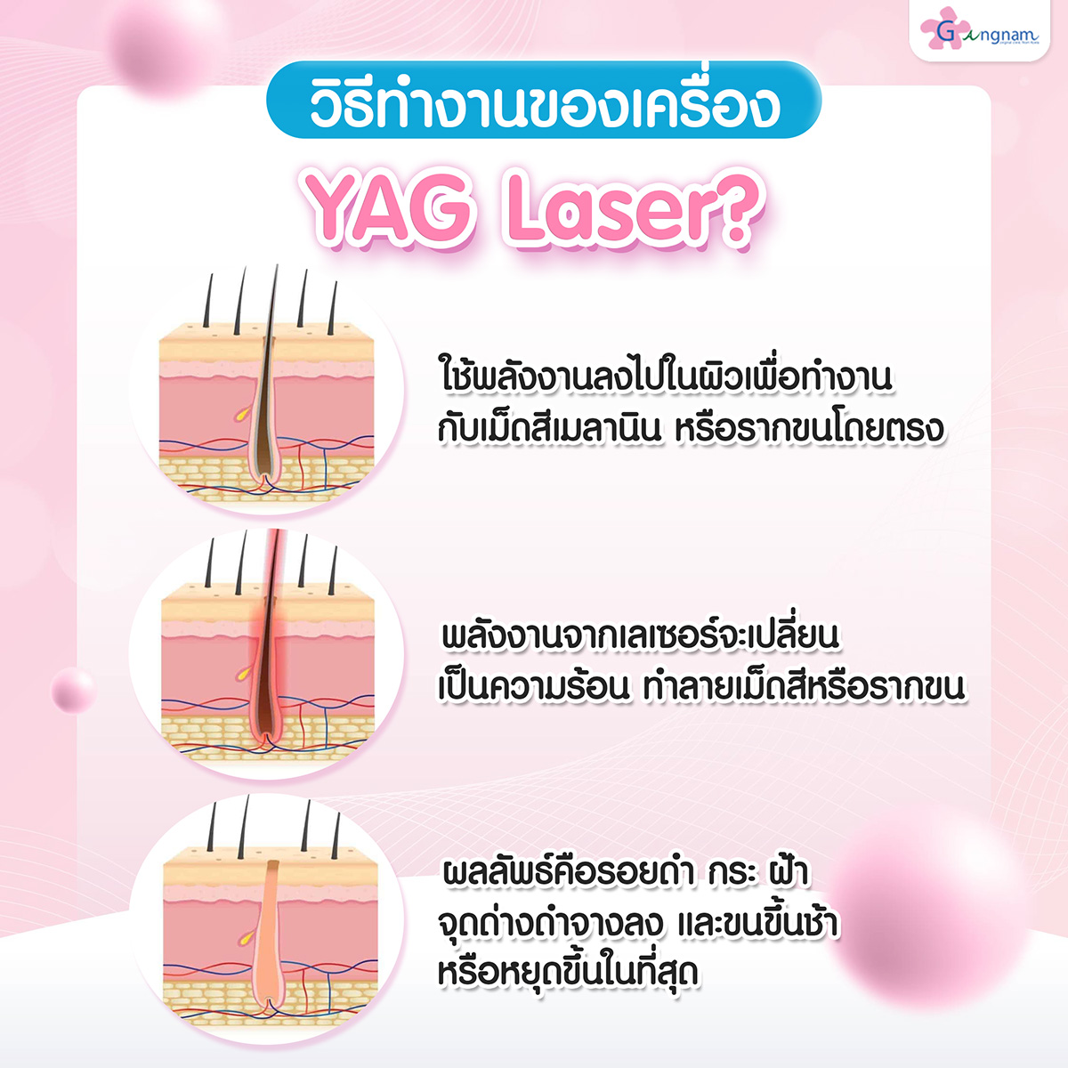 วิธีทำงานของเครื่องYAG Laser