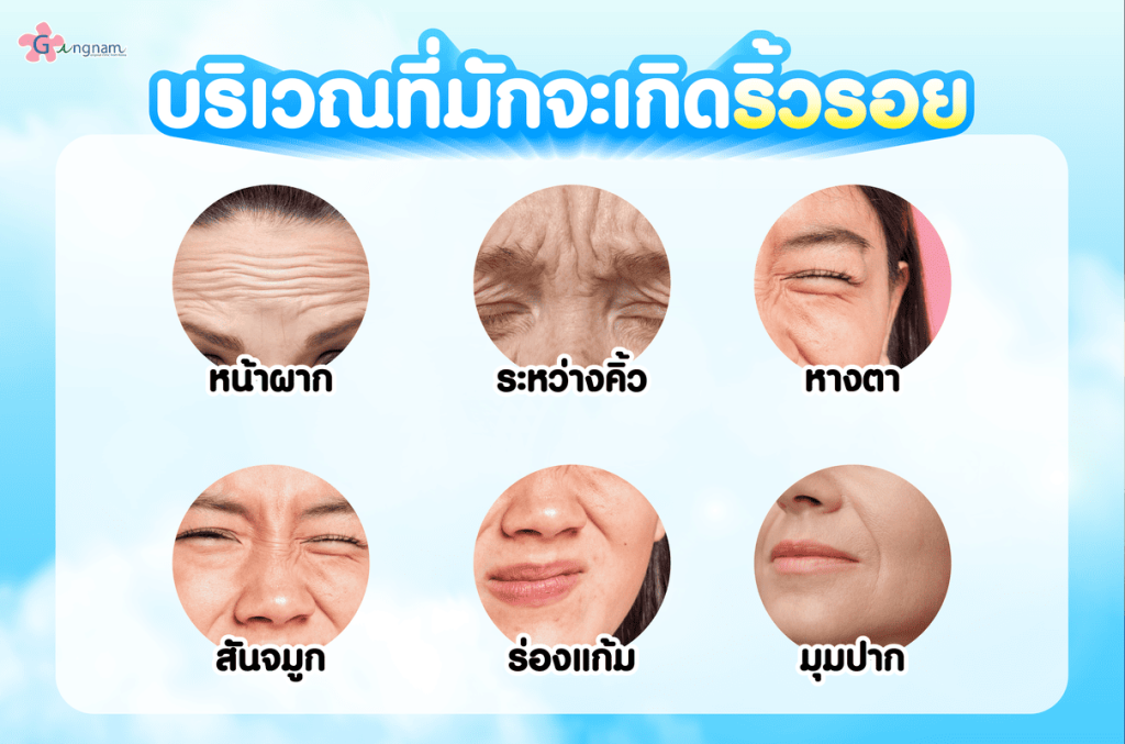 บริเวณที่เกิดริ้วรอย