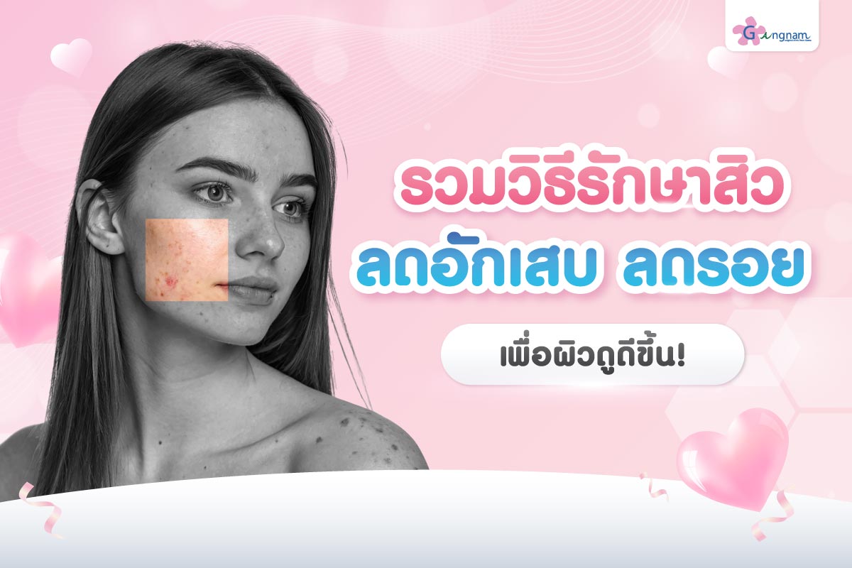 รักษาสิวด้วยตัวเอง ทำอย่างไรดี? ด้วยแนวทางที่คุณทำเองได้