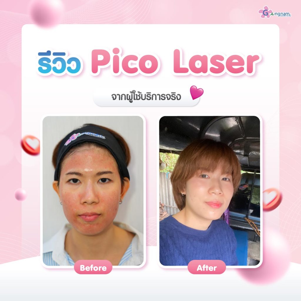 เปรียบเทียบผลลัพธ์หลังทำpico-laser 02