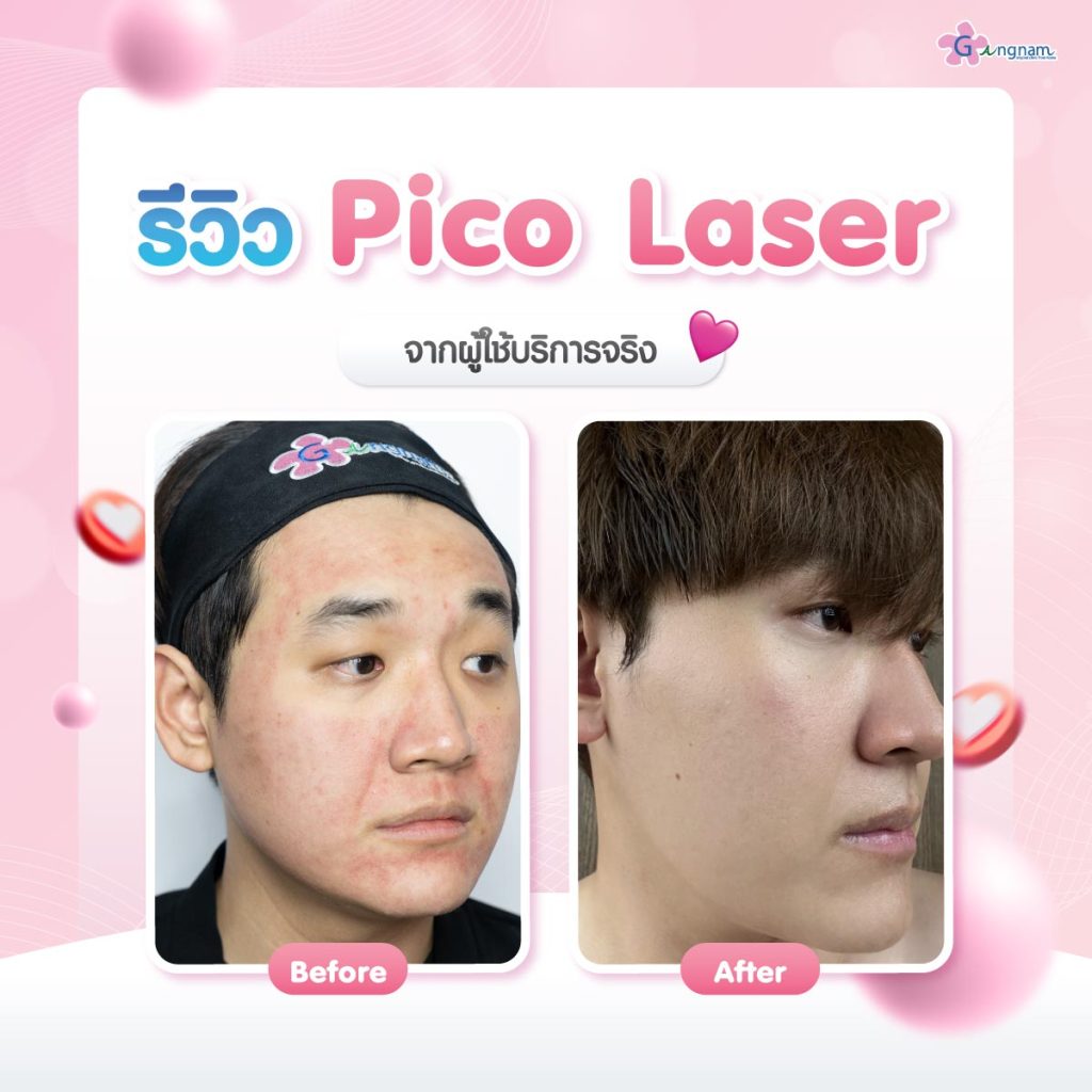 เปรียบเทียบผลลัพธ์หลังทำpico-laser 03