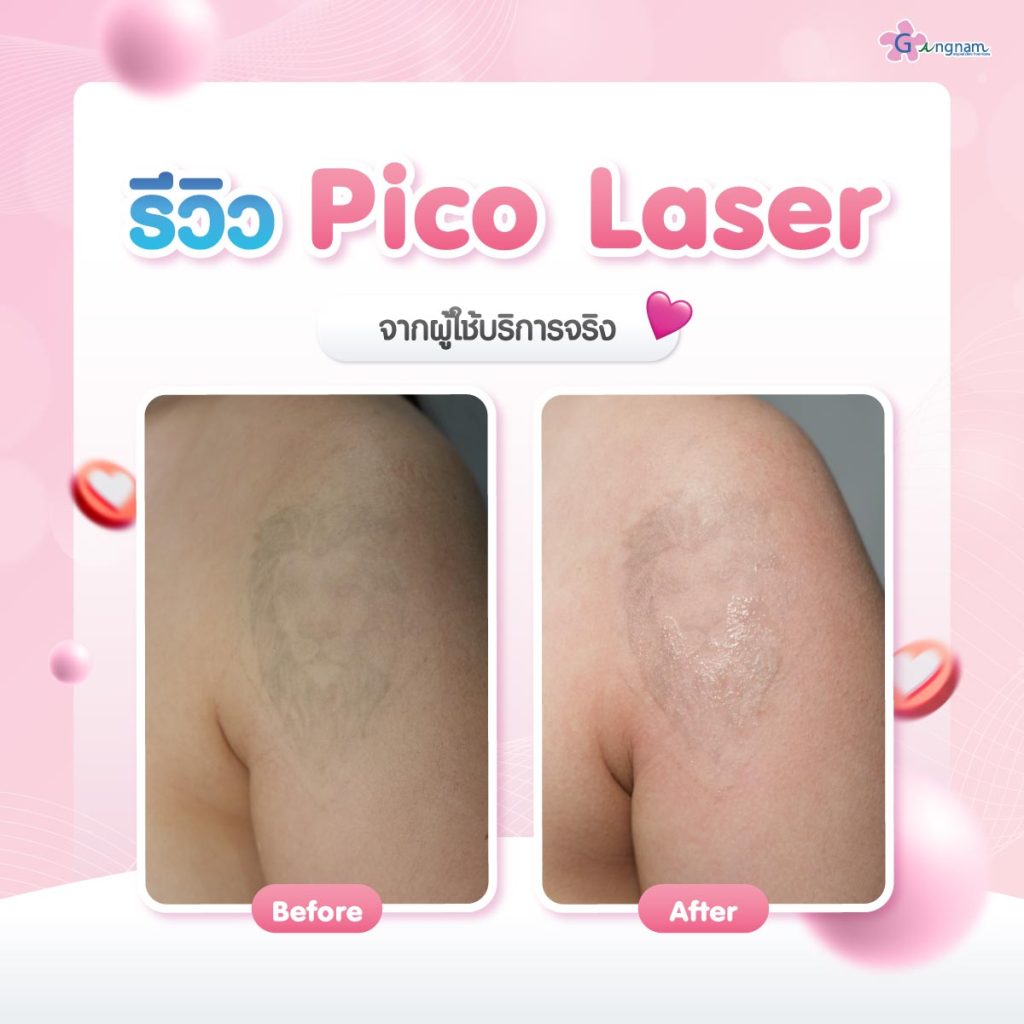 เปรียบเทียบผลลัพธ์หลังทำpico-laser 04