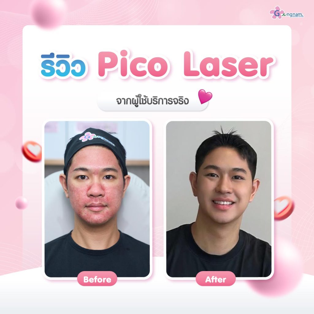 เปรียบเทียบผลลัพธ์หลังทำpico-laser