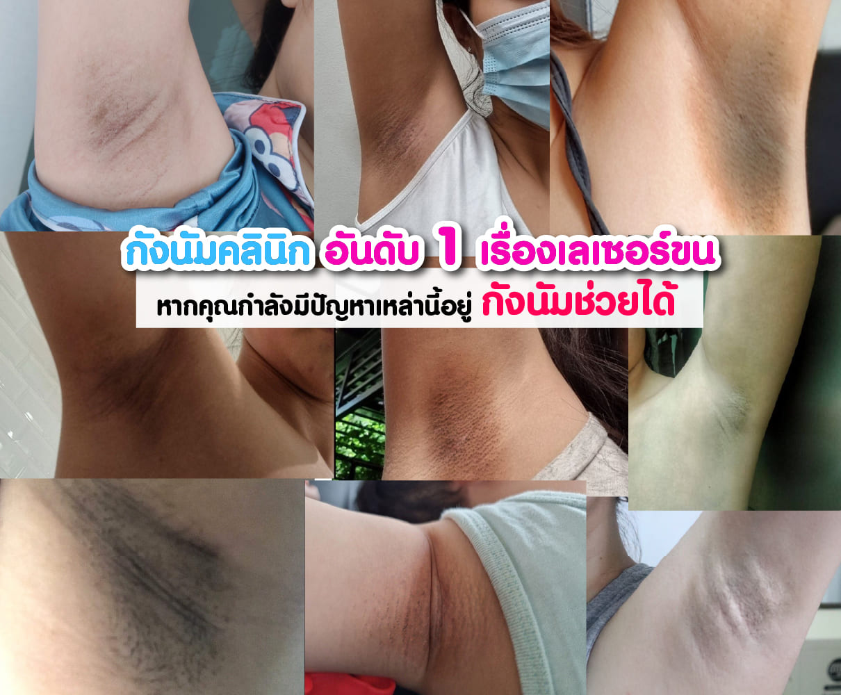 ปัญหาขน ที่ต้องเลเซอร์ขน