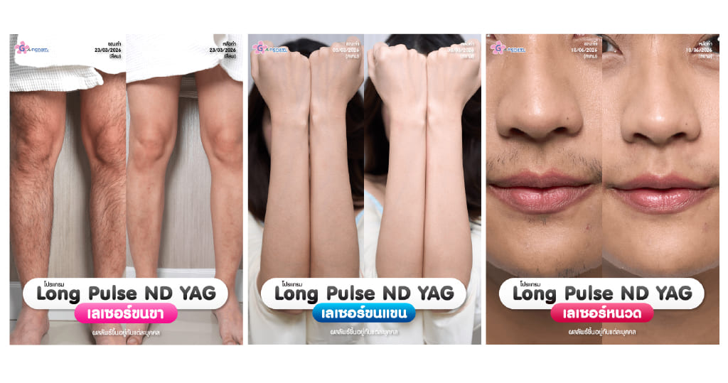 รีวิวเลเซอร์ขนด้วยเครื่อง long pulse nd yag-2