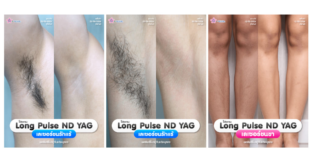 รีวิวเลเซอร์ขนด้วยเครื่อง long pulse nd yag-3
