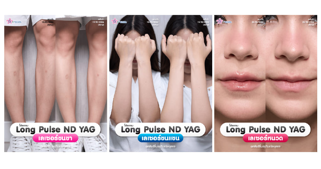 รีวิวเลเซอร์ขนด้วยเครื่อง long pulse nd yag-4