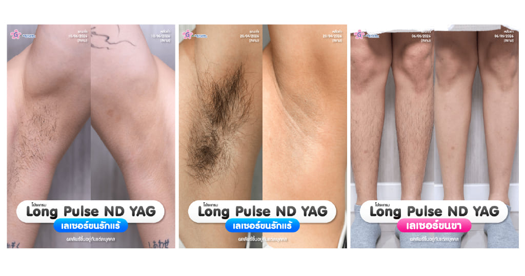รีวิวเลเซอร์ขนด้วยเครื่อง long pulse nd yag