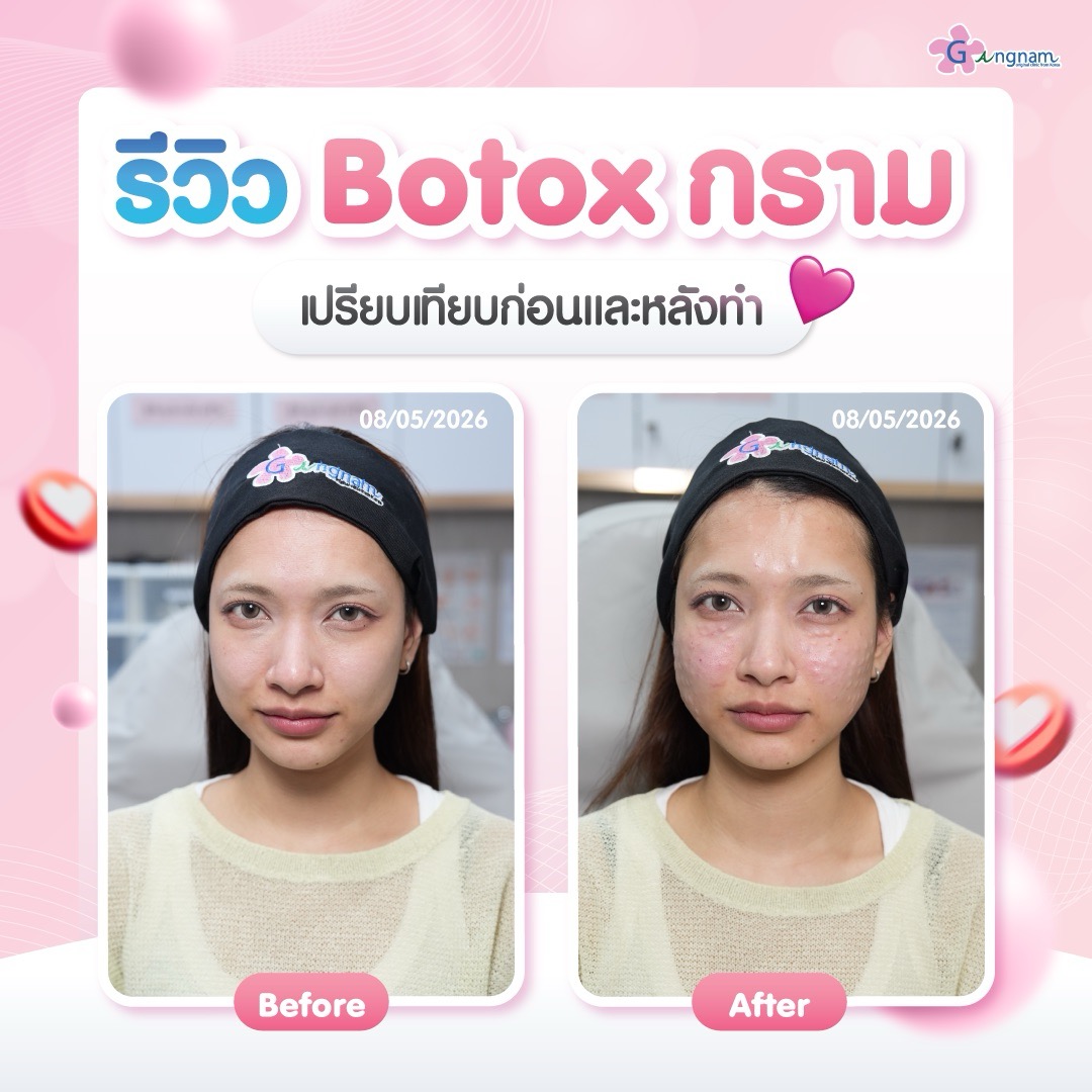รีวิว ผู้หญิงวัย28ทำBotox กราม
